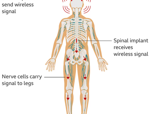 Un hombre paralítico vuelve a caminar gracias a implantes en su cerebro, médula espinal y piernas