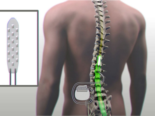 Consiguen que un paralítico vuelva a andar gracias a un electroestimulador